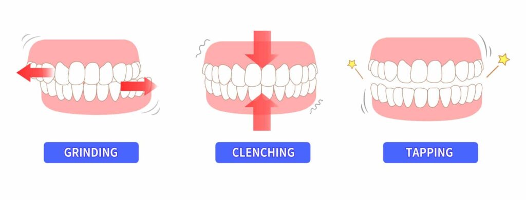 types of bruxism. showing which ways you can grind your teeth