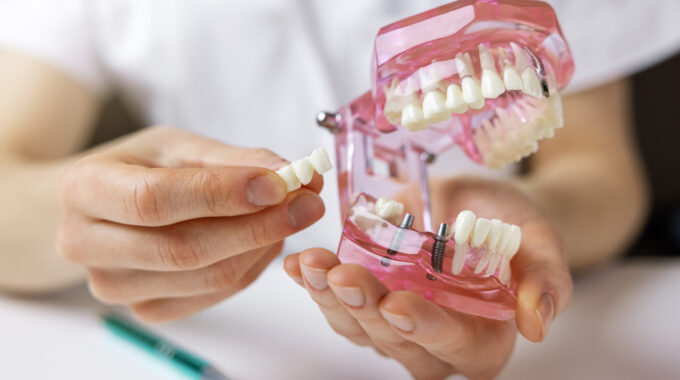 dental implant consultation at Pleasant Street Dental in East Longmeadow MA