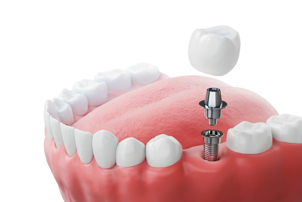 3D diagram showing the three parts of a dental implant — titanium post, abutment, and crown — East Longmeadow MA dentist
