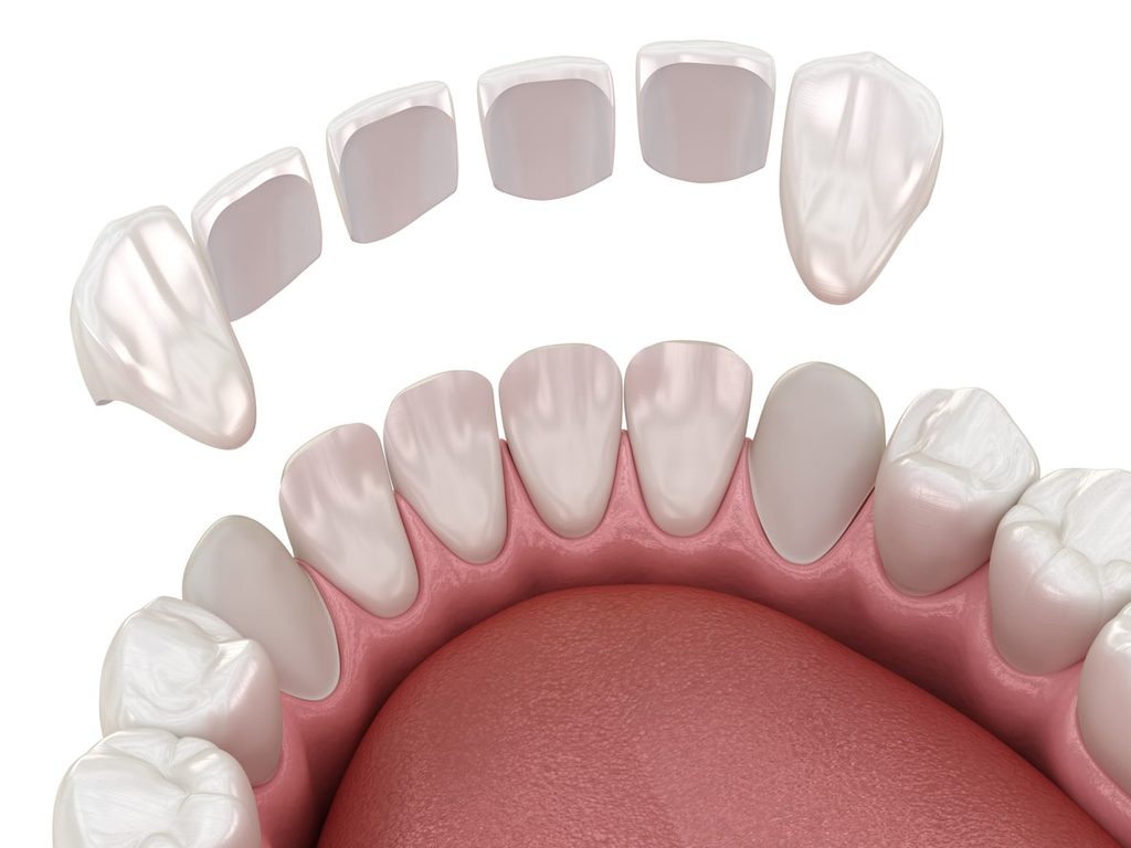 3D Illustration of thin porcelain veneers being placed over the front teeth.