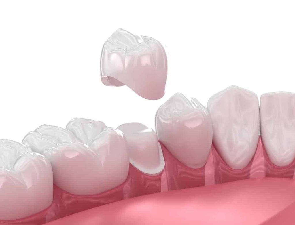 3D illustration of a dental crown being placed over a prepared tooth.